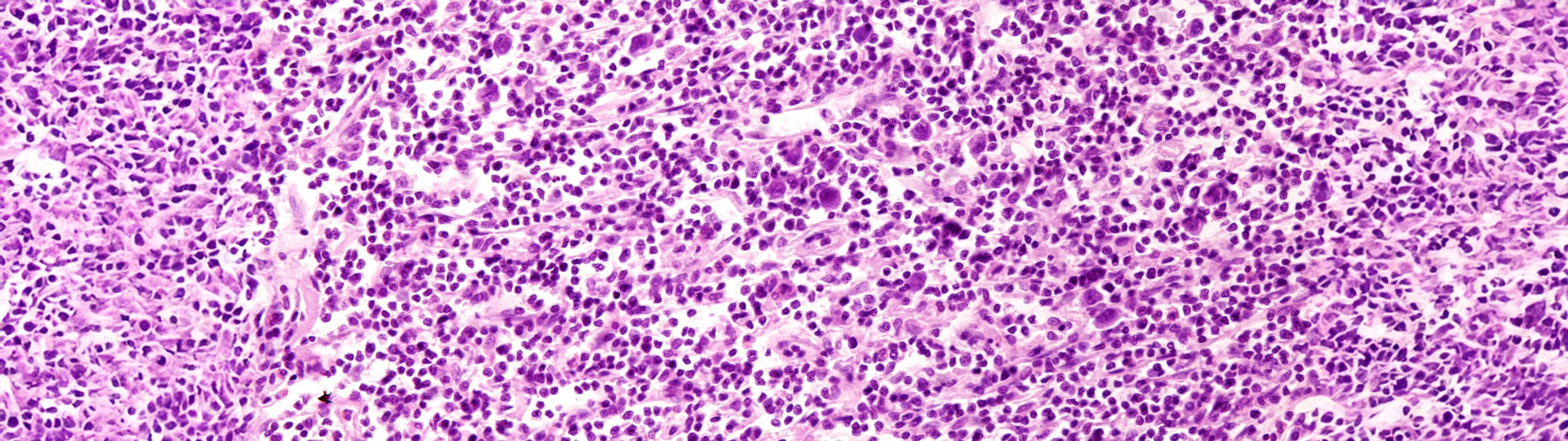 Lymphome DTZ Therapie GbR