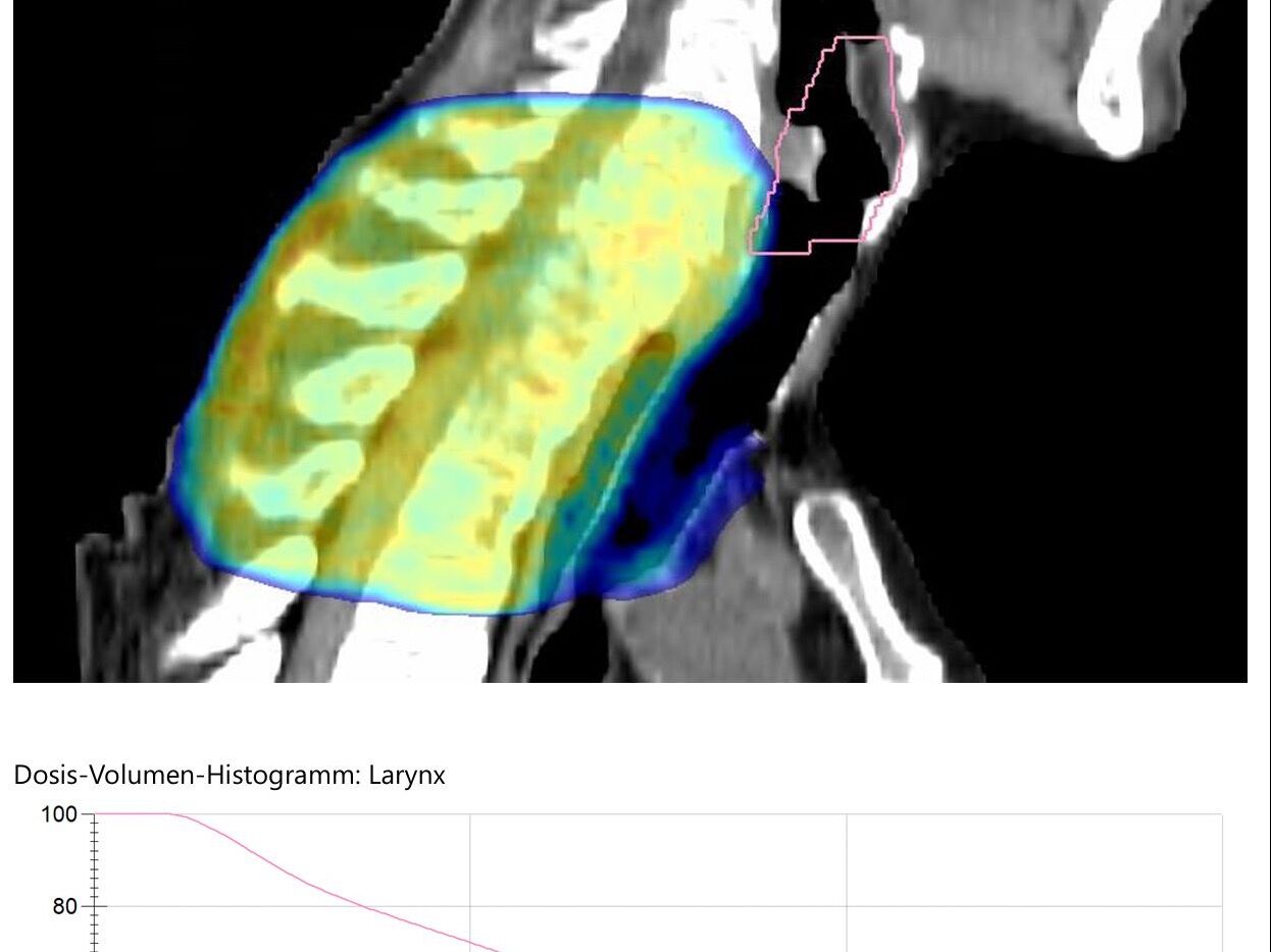 Bestrahlungsplan der Halswirbelsäule mit Dosisverteilung und Dosis-Volumen-Histogramm des Kehlkopfs